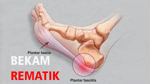 Illustration for article titled Obat Asam Urat Ampuh